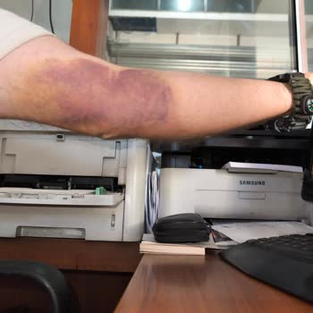 Türk Kızılay Kan Bağışı Sonrası Kolumda Ağrı Ve Morarma Yaşadım!