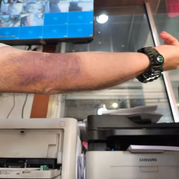 Türk Kızılay Kan Bağışı Sonrası Kolumda Ağrı Ve Morarma Yaşadım!