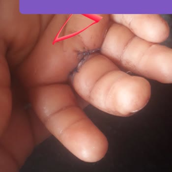 Kapalı Niğde Gazoz Şişesi Patladı, Çocuğum Yaralandı Ve Ameliyat Oldu