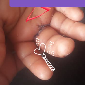 Kapalı Niğde Gazoz Şişesi Patladı, Çocuğum Yaralandı Ve Ameliyat Oldu