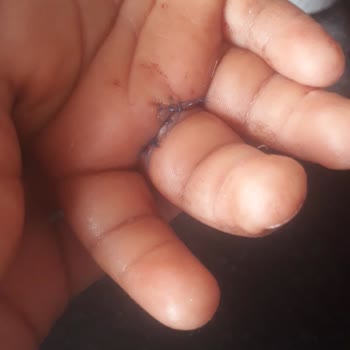 Kapalı Niğde Gazoz Şişesi Patladı, Çocuğum Yaralandı Ve Ameliyat Oldu