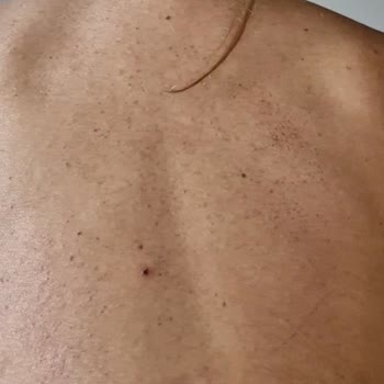 SPA Hizmetinde Eksik Ve Hatalı Uygulama Sonrası Ciddi Cilt Hasarı Yaşadım