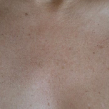 SPA Hizmetinde Eksik Ve Hatalı Uygulama Sonrası Ciddi Cilt Hasarı Yaşadım