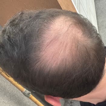 Saç Ekimi Operasyonunda Beklentilerin Karşılanmaması Ve Estetik Memnuniyetsizlik