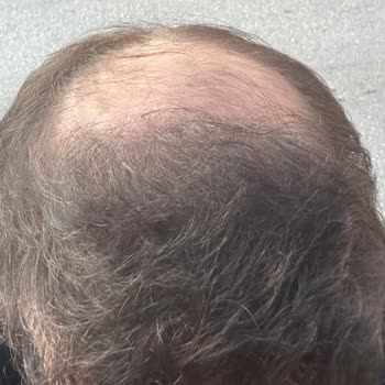 Saç Ekimi Operasyonunda Beklentilerin Karşılanmaması Ve Estetik Memnuniyetsizlik