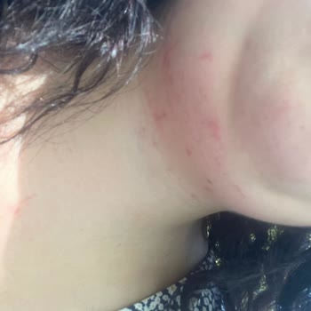 Lazer Epilasyon Sonrası Cilt Yanıkları Ve Sonuçsuz Beyazlatma İşlemi Nedeniyle Mağduriyet