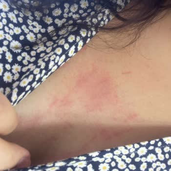 Lazer Epilasyon Sonrası Cilt Yanıkları Ve Sonuçsuz Beyazlatma İşlemi Nedeniyle Mağduriyet