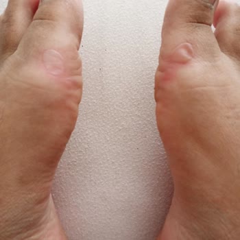 Aldığım Sandalet Ayağımı Yaraladı, Değişim Talebim Reddedildi