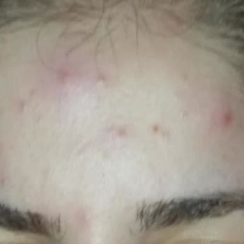 Kullandığım Cilt Bakım Kremi Cildimde Sivilce Yaptı, Ücret İadesi Talep Ediyorum