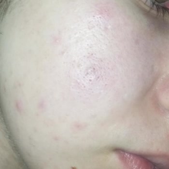 Kullandığım Cilt Bakım Kremi Cildimde Sivilce Yaptı, Ücret İadesi Talep Ediyorum