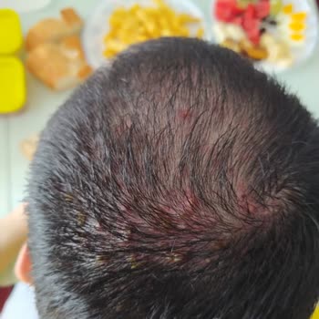 Şampuan Ciddi Sağlık Sorunlarına Yol Açtı, Satıcı Ve Marka Sessiz Kaldı