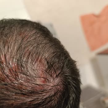 Şampuan Ciddi Sağlık Sorunlarına Yol Açtı, Satıcı Ve Marka Sessiz Kaldı