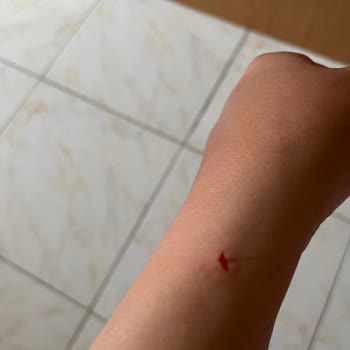 Duşakabin Kazası Sonrası İlgisiz Otel Yönetimi Mağduriyetimi Artırdı