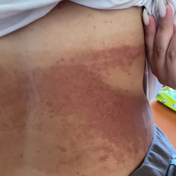 Bronzlaştırıcı Krem Cildimde Yanık Ve Lekelere Sebep Oldu