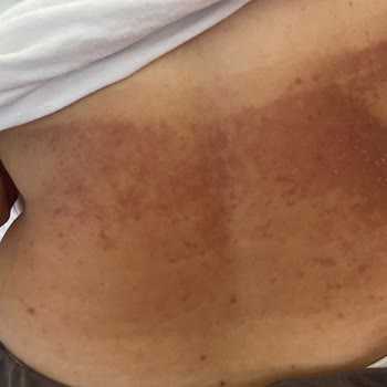 Bronzlaştırıcı Krem Cildimde Yanık Ve Lekelere Sebep Oldu