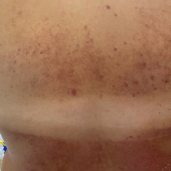 Bronzlaştırıcı Krem Cildimde Yanık Ve Lekelere Sebep Oldu