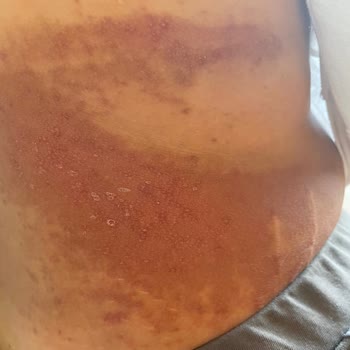 Bronzlaştırıcı Krem Cildimde Yanık Ve Lekelere Sebep Oldu