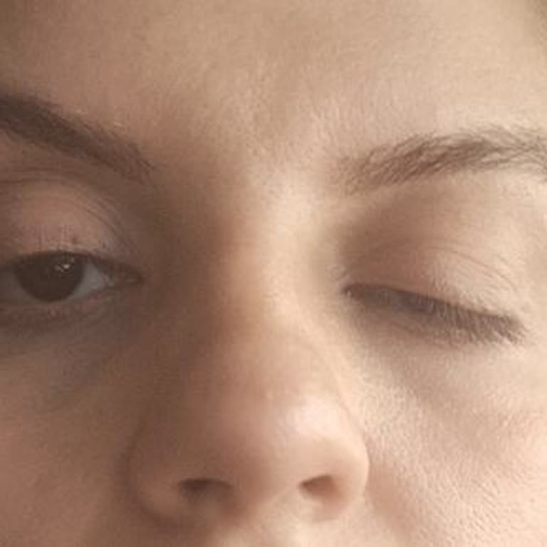 Botoks Sonrası Ciddi Sağlık Sorunlarıma Çözüm Sunulmadı