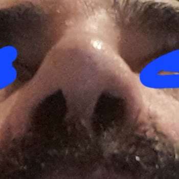 Prof. Dr. Mithat Akan Burun Dolgusu Sonrası Çökme Ve Nefes Problemi Çözülemedi