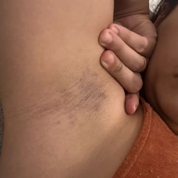 Yves Rocher Roll-on Ürünü Ciltte Tahriş Ve Kararma Yaptı, Geri Dönüş Alamadım