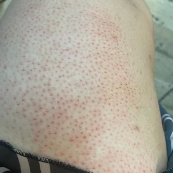 Kullanım Talimatına Rağmen Kristal Tüy Dökücü Ciddi Tahrişe Sebep Oldu