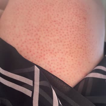 Kullanım Talimatına Rağmen Kristal Tüy Dökücü Ciddi Tahrişe Sebep Oldu