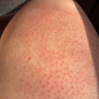 Kullanım Talimatına Rağmen Kristal Tüy Dökücü Ciddi Tahrişe Sebep Oldu