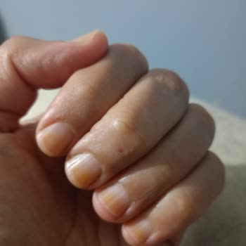 Oje Kullanımı Sonrası Tırnaklarda Turunculaşma Ve Sağlık Endişesi