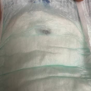 Molfix Bebek Bezlerinde Yabancı Cisim Ve Sızdırma Sorunu