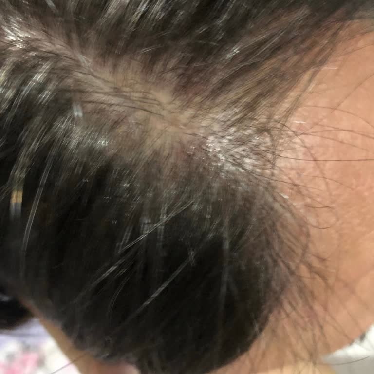 Bioxcin Forte Şampuan Saç Dökülmesine Çözüm Olmadı