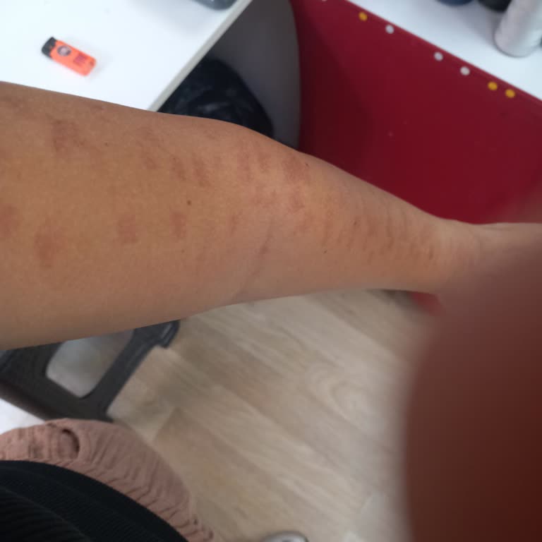 Alaşehir Sarıkız Hastanesi'nde İlgisiz Personel Nedeniyle Kolumda Yanık Oluştu