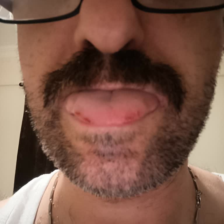 Listerine Cool Mint Sonrası Ağızda Yanma Ve Yara Oluşumu