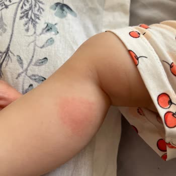 Koçak Farma İlaç Vegaferon Bebeğimde Alerjik Reaksiyona Sebep Oldu!