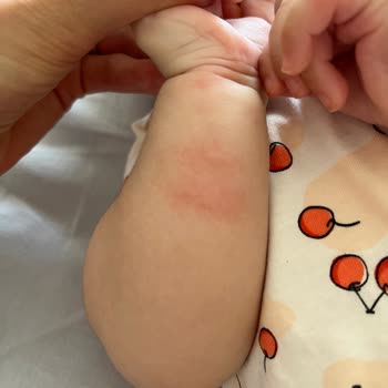 Koçak Farma İlaç Vegaferon Bebeğimde Alerjik Reaksiyona Sebep Oldu!