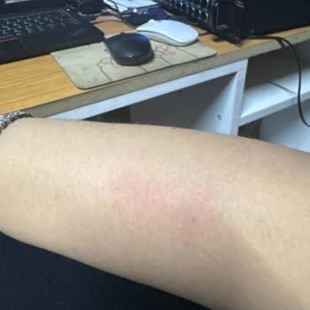 Зуд и покраснение после использования Off репеллента