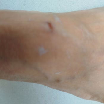 Ceyo Terlik Bantları Ayağımı Yaraladı, Mağduriyetim Giderilmiyor
