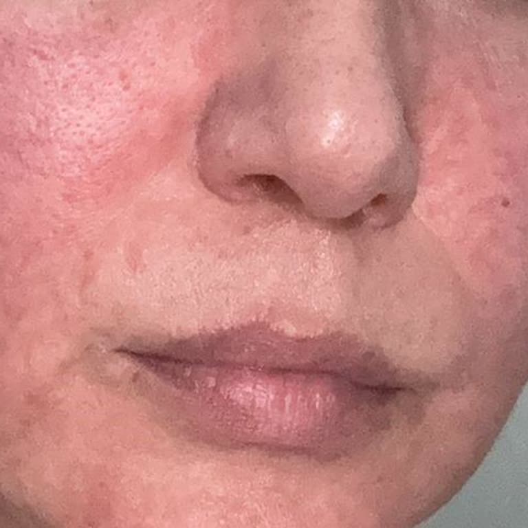 Skinsensual C Vitamini Serumu Cildimde Ciddi Alerjik Reaksiyona Yol Açtı