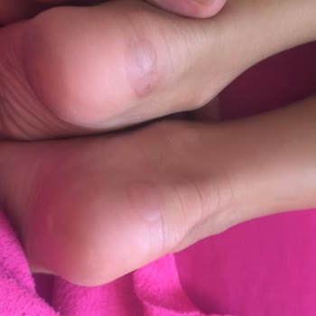 Lotto Krampon, ambos modelos dañaron los pies de mi hijo