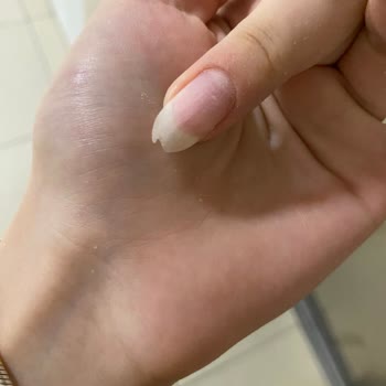 Protez Tırnak İşlemi Sonrası Tırnakta Zarar Ve Yetersiz Çözüm