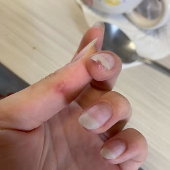 Protez Tırnak İşlemi Sonrası Tırnakta Zarar Ve Yetersiz Çözüm