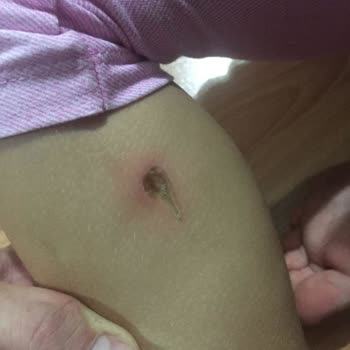Yanlış Bağlanan Koter Plağı Sonrası Kızımızın Bacağında Kalıcı Yanık İzi Oluştu