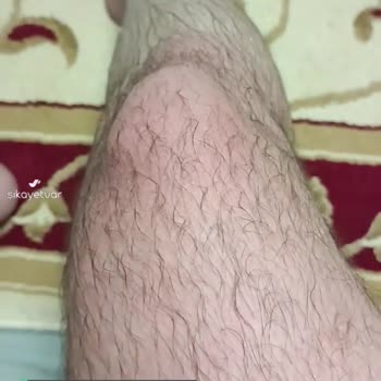 Dehre Lokman Fermojin Krem Bacağımı Yaktı!
