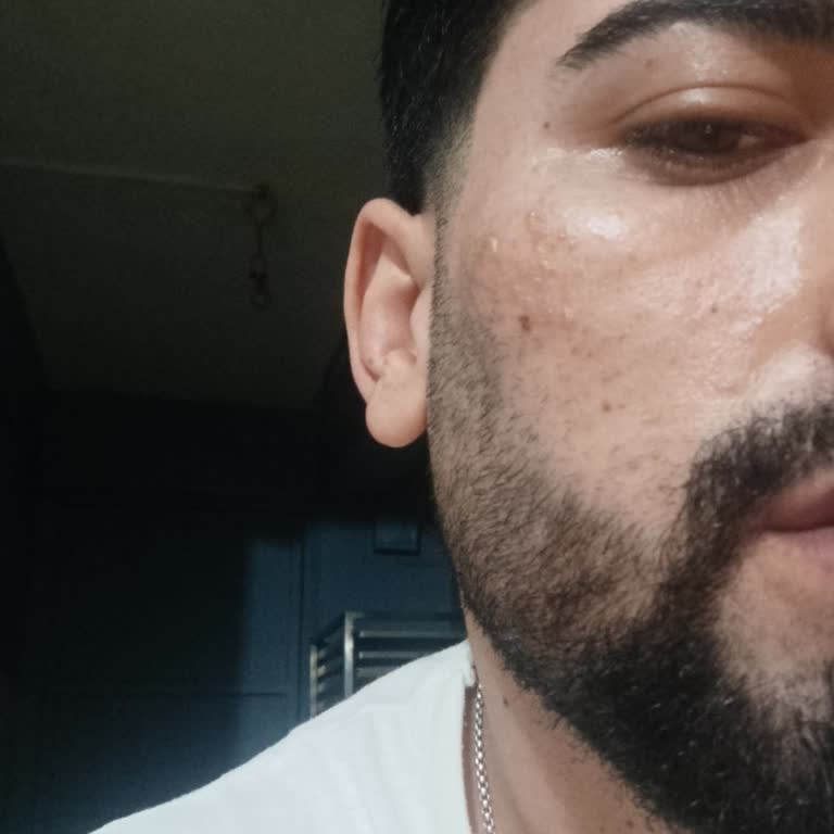 Lazer Epilasyon Sonrası Yüzümde Yanık Ve Şişme Oluştu, İlgisiz Davranıldı