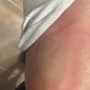 Kısa Sürede Deforme Olan Ayakkabı İçin Ret Ve İade Sorunu