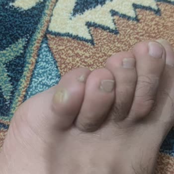 Aldığım Ayakkabı Sürekli Ayağımı Vuruyor, Çözüm Bekliyorum