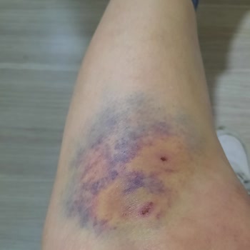 Köpek Saldırıları Ve Güvenlik Zafiyeti!