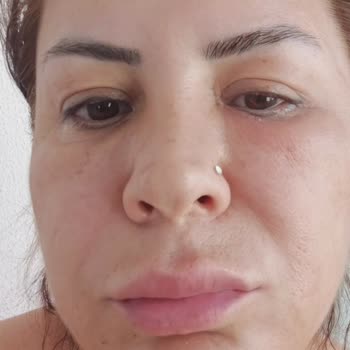 Dr. Veysel Durak Botoks Sonrası Göz Kapağında Düşüklük Ve Yetersiz Çözüm