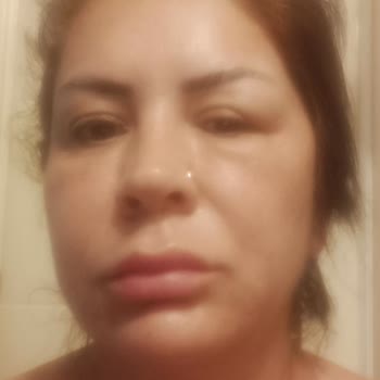 Dr. Veysel Durak Botoks Sonrası Göz Kapağında Düşüklük Ve Yetersiz Çözüm