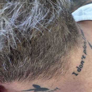 Tech Hair Protez Saç Merkezi Yapılan İşlem Sırasında Saçlarım Yakıldı