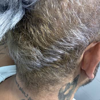 Tech Hair Protez Saç Merkezi Yapılan İşlem Sırasında Saçlarım Yakıldı